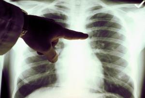 Cáncer de pulmón: síntomas y diagnóstico