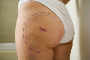 La celulitis