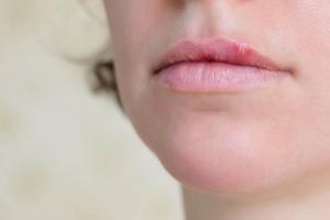 Cómo curar un herpes labial