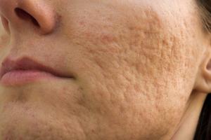 Cómo eliminar las cicatrices del acné