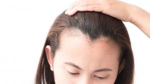 Como hacer frente a la alopecia femenina