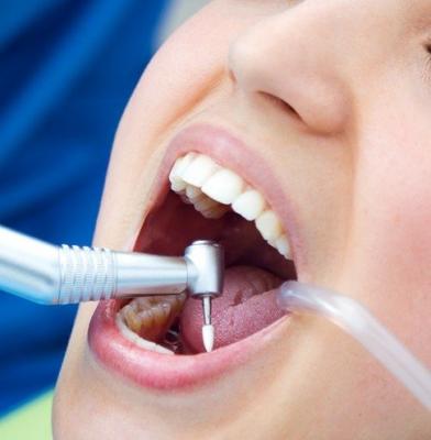¿En qué consiste una limpieza dental y a qué clínica acudir?