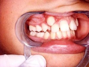 Dientes api&ntilde;ados