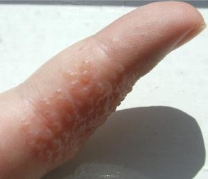 Eczema dishidrótico: guía informativa