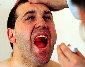 Herpes y Candidiasis orales