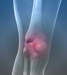 Lesiones de partes blandas de la rodilla