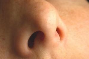 Poliposis nasal