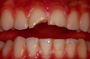 Prevenci&oacute;n de fracturas dentales en el deporte