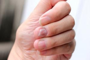 Qué es la psoriasis ungueal y cómo tratarla eficazmente