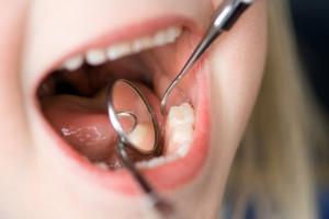  El tratamiento de la caries dental