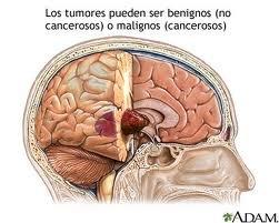 tumor