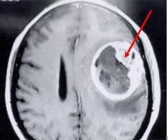 tumor2